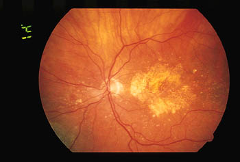 Common Concerns: Macular Degeneration